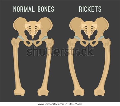 Normal Bones Versus Rickets Osteomalacia Medical Stock Vector Royalty