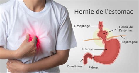 Hernie De L Estomac Description Types De Hernie Causes