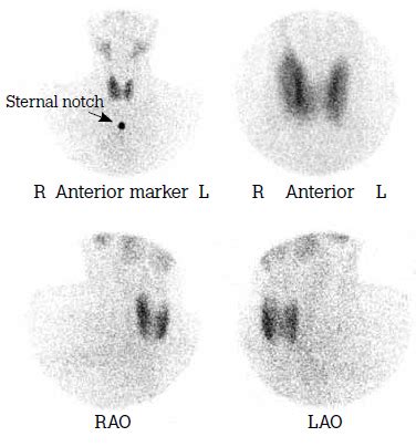 RACGP - Thyroid scans