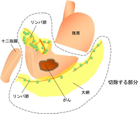 胃がんの手術について 国立がん研究センター 東病院