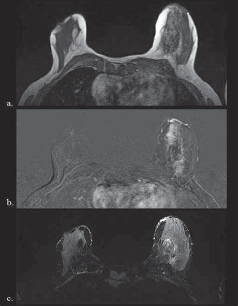 Immagini Di Risonanza Magnetica Mammaria Per Bilancio D Estensione In