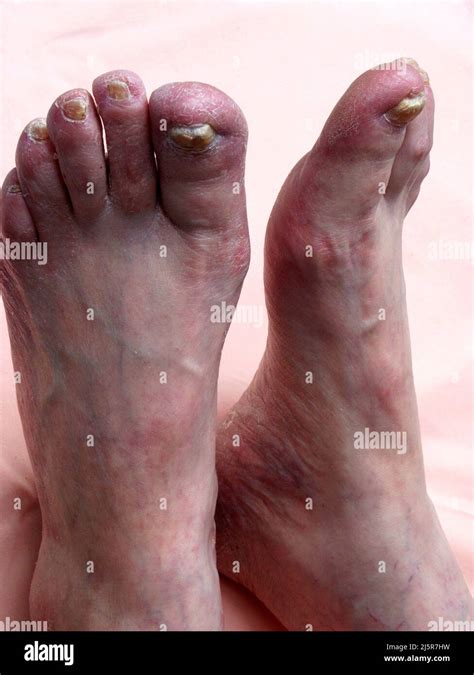 Toenail Fungal Infection Onychomycosis Stock Photo Of Yellow Nails