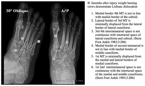 Lisfranc Injury X Ray