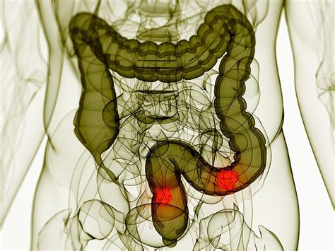 Niveles altos de vitamina D se relacionan con menor riesgo de cáncer