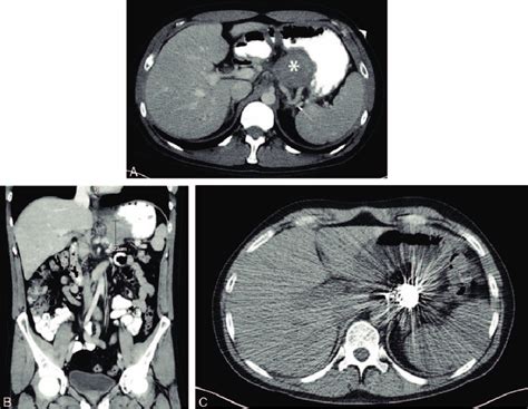 A Axial View Of Abdominal CT With IV Contrast Shows A 5 2 Cm