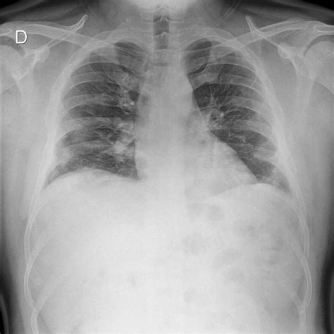 Chest Radiograph Obtained On Admission Shows Peripheral Ground Glass Download Scientific