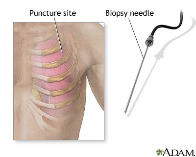 Pleural needle biopsy | UF Health, University of Florida Health