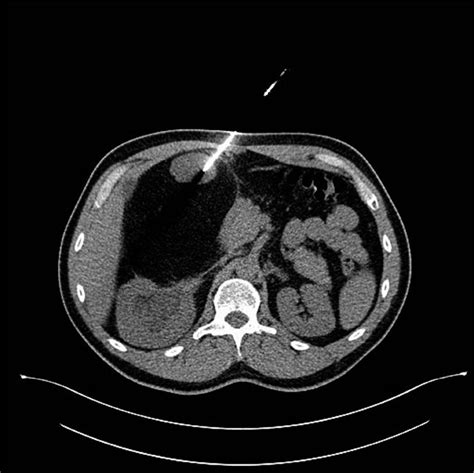 Computed Tomography Guided Biopsy The Tip Of The Needle Is Correctly Download Scientific