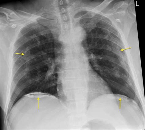 Asbestos plaques - Radiology at St. Vincent's University Hospital