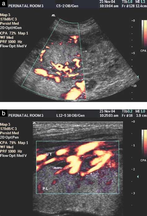 Antenatal Diagnosis Of Non‐previa Placenta Increta With Histological