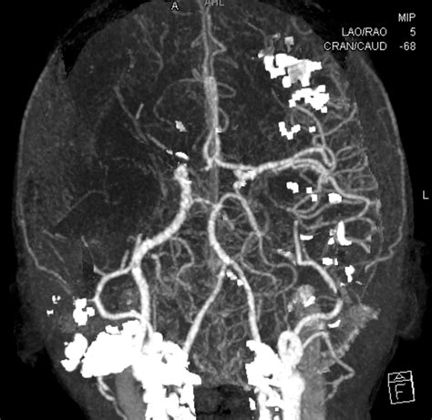 Septic Emboli With Bilateral Carotid Occlusion And Thrombecromy