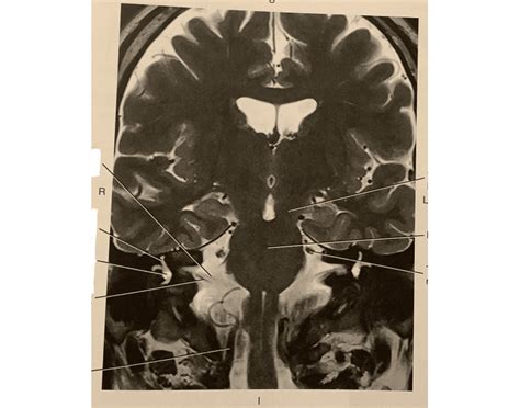 Coronal, MRI of facial and vestibulocochlear nerve Quiz