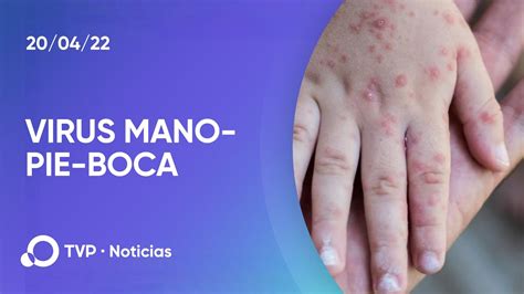 Alerta Por El Regreso Del Virus Mano Pie Boca YouTube