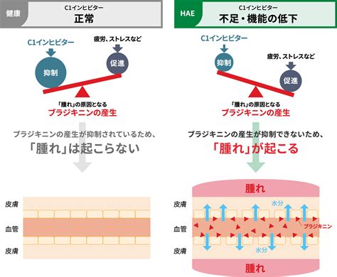 難病 遺伝性血管性浮腫hae