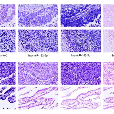 A Microrna In Situ Hybridization Of Human Mesothelioma Tissues