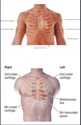 Midclavicular Line 5th Intercostal Space