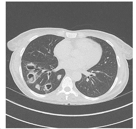 Thoracic CT scan showing a cavitary community-acquired pneumonia due to... | Download Scientific ...