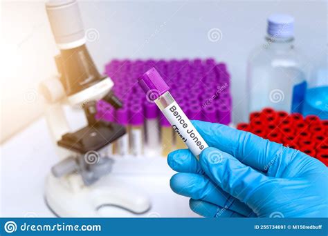 Muestras De Orina Para La Prueba De Las Jonas De La Bence En El