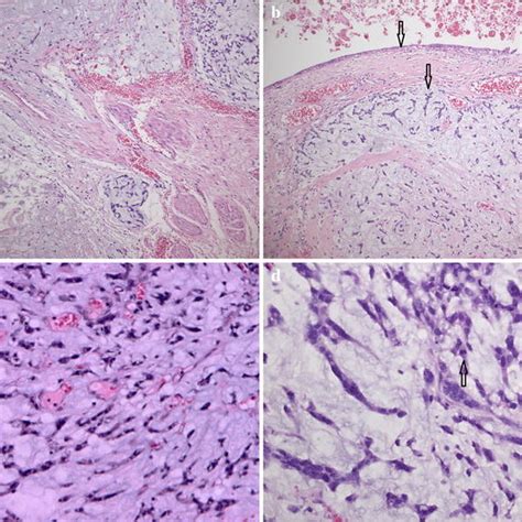 Gross Specimen Of Ovarian Cystic Mass With Mural Nodule A Solid Mural