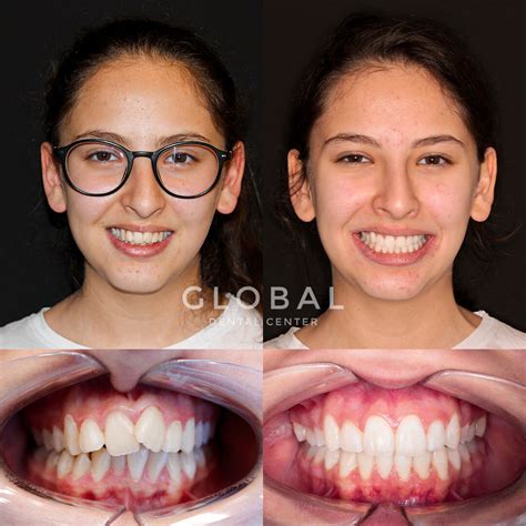 Invisalign Global Dental Center Turkey Dental Clinic In Antalya Turkey