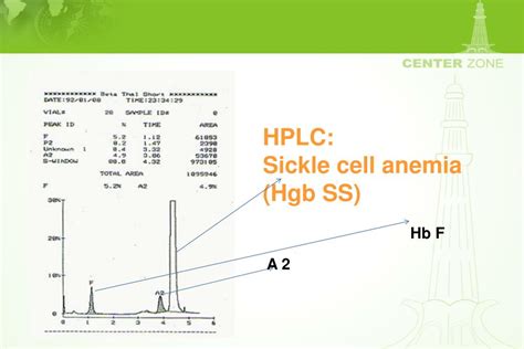 Ppt Diagnostic Hematology Disorders Of Hemoglobin And Gammopathies