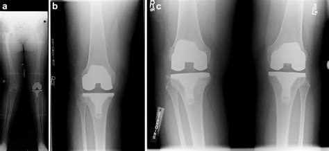 A Anteroposterior Ap Long Leg Preoperative Radiographs From