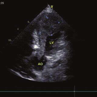 Two Dimensional Echocardiography Showing Large Left Ventricular