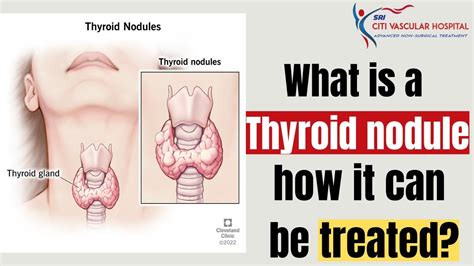 Thyroid Nodule What Is A Thyroid Nodule And How It Can Be Treated