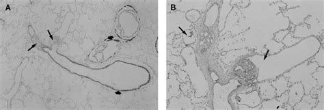 Longitudinal Views Of Plexiform Lesions In PPH A Low Power