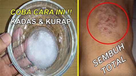 AMPUH Kadas Kurap Luntur Sembuh Total Dengan Obat Ini YouTube