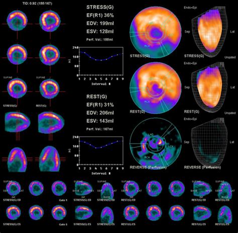 Nuclear Medicine Exam Pet Ct Ucsf Radiology