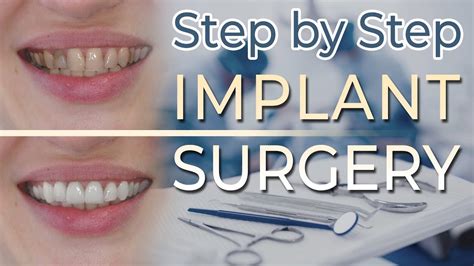 Dental Implant Surgery Step By Step Implant Exposure Youtube