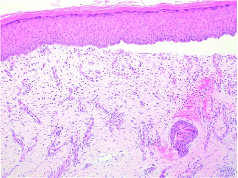 Histopathology Punch Biopsy Specimens Revealed A Paucicellular Download Scientific Diagram