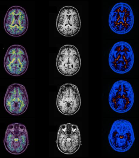 Normal Amyloid Pet Example Note Normal Uptake Of Pib Pittsburg