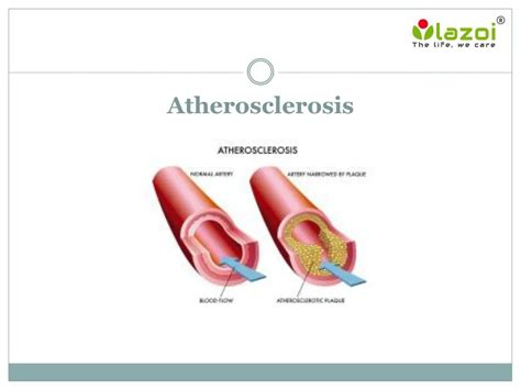 Ppt Atherosclerosis Powerpoint Presentation Free Download Id 7625269