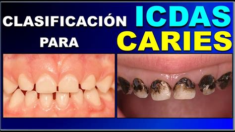 Icdas En Odontopediatria Clasificacion De Caries En Odontologia