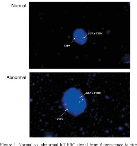 Pdf Genomic Amplification Of Hpv H Terc And C Myc In Liquid Based