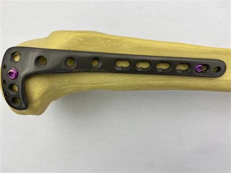 High Quality Pure Titanium Orthopedic Implants Proximal Tibial Lateral