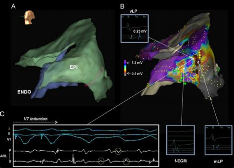 Electroanatomical Maps Of The Endocardial And Epicardial Left Ventricle