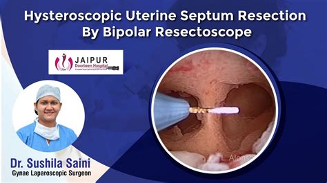 Hysteroscopic Uterine Septum Resection By Bipolar Resectoscope YouTube