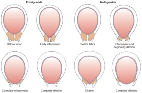 Intrapartum Flashcards Quizlet