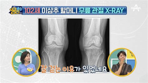 102세 맞죠 문제점 하나 없이 완벽한 무릎 관절 X Ray 나는 몸신이다 383 회 Youtube