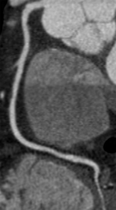 Coronary Ct Angiography Of Patients With A Normal Body Mass Index Using