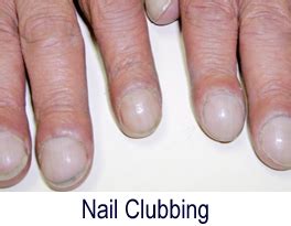 Clubbed Fingers And Nails Causes And What They Look Like Off