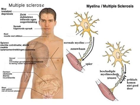 Multiple Sclerose MS Neurologische Aandoeningen