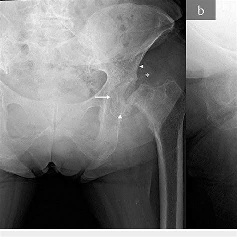 Anteroposterior Radiographs Anteroposterior A And Lateral B Download Scientific Diagram