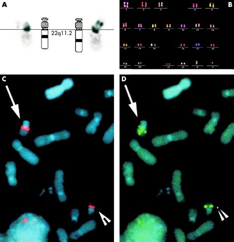 Partial Trisomy Of Chromosome 22 Resulting From An Interstitial