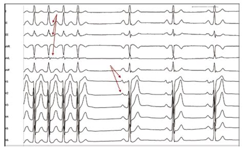 Atrial Tachycardia Originating From The Pulmonary Vein Clinical