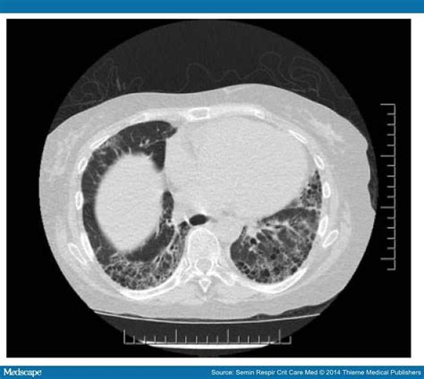 Pulmonary Manifestations Of Systemic Lupus Erythematosus 5824 Hot Sex Picture