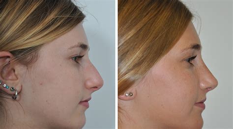 Rhinoplastie Avant Apres Les Photos Des Meilleures Rhinoplasties